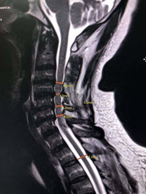 injecting local anesthetic and steroid into the area where the spinal nerves exit (lumbar, cervical, or thoracic). . Cervical spinal stenosis settlement